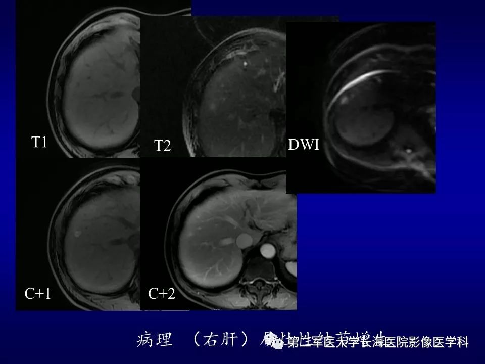 影像PPT - 肝细胞性结节的病理特点及影像诊断-21