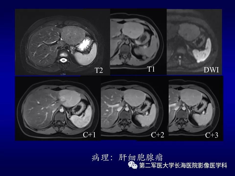 影像PPT - 肝细胞性结节的病理特点及影像诊断-25
