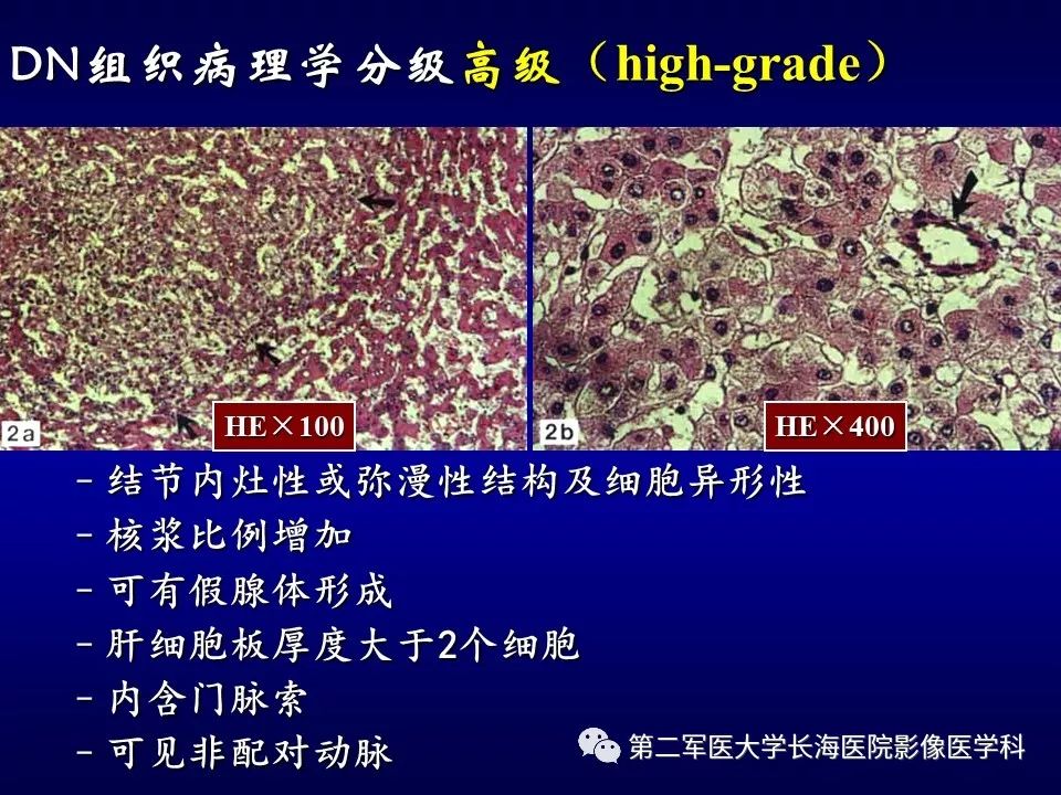 影像PPT - 肝细胞性结节的病理特点及影像诊断-29