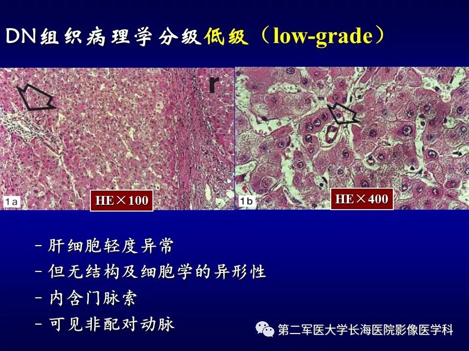 影像PPT - 肝细胞性结节的病理特点及影像诊断-28