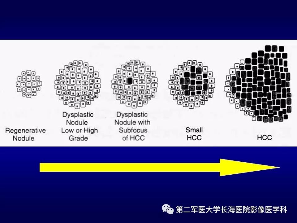 影像PPT - 肝细胞性结节的病理特点及影像诊断-30