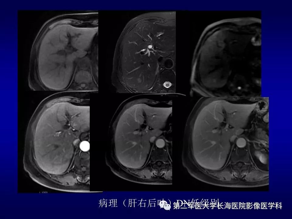 影像PPT - 肝细胞性结节的病理特点及影像诊断-41