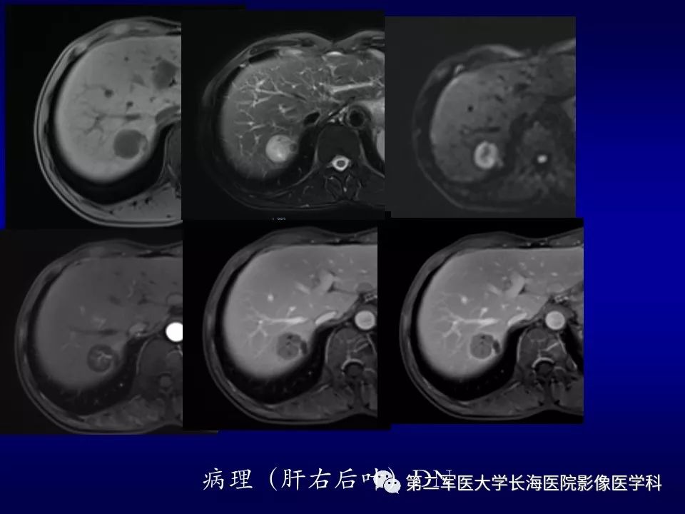 影像PPT - 肝细胞性结节的病理特点及影像诊断-43