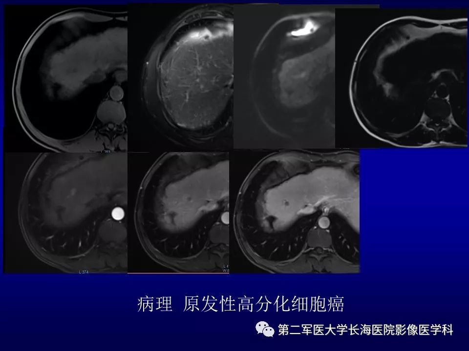 影像PPT - 肝细胞性结节的病理特点及影像诊断-44