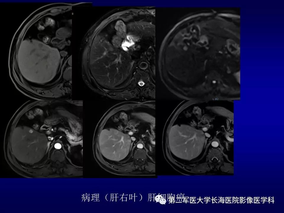 影像PPT - 肝细胞性结节的病理特点及影像诊断-46