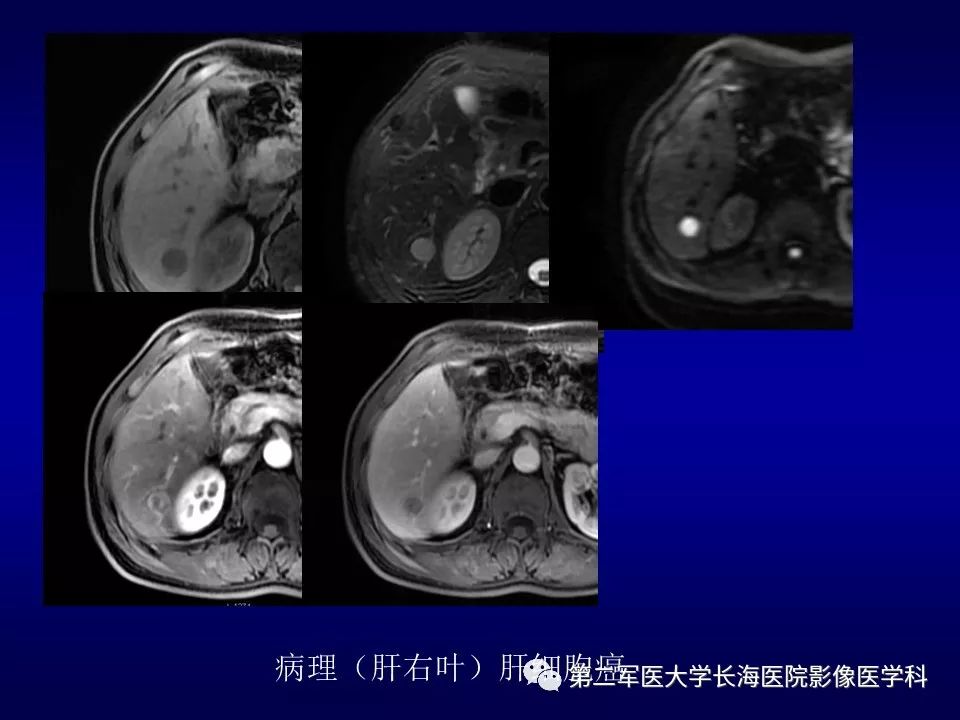 影像PPT - 肝细胞性结节的病理特点及影像诊断-45