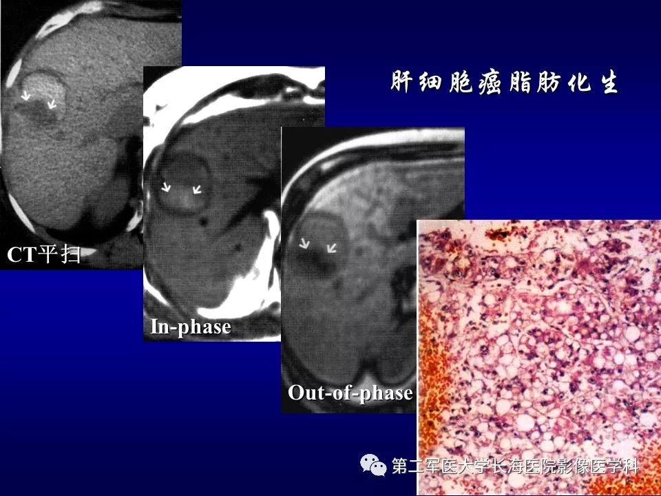 影像PPT - 肝细胞性结节的病理特点及影像诊断-47
