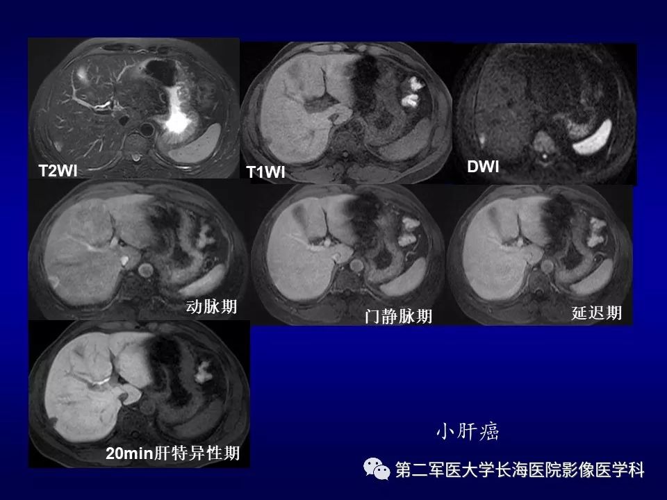 影像PPT - 肝细胞性结节的病理特点及影像诊断-49