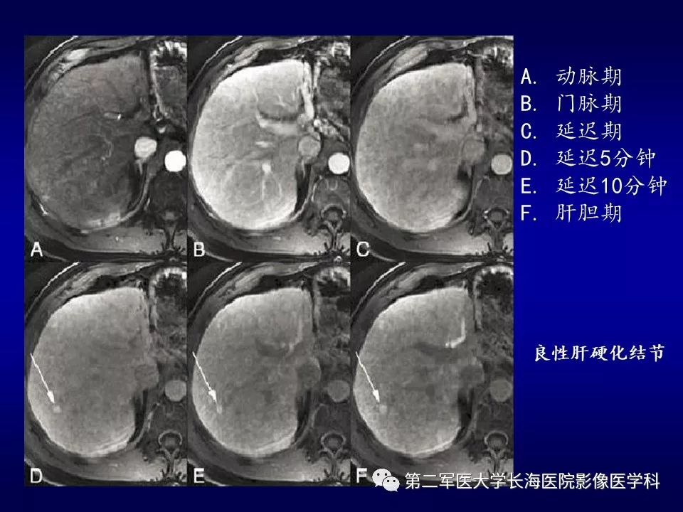 影像PPT - 肝细胞性结节的病理特点及影像诊断-48