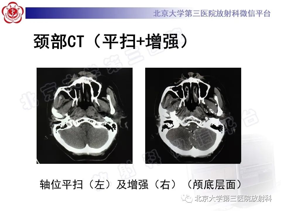 影像PPT - 【PPT】甲状旁腺腺瘤自发破裂-3