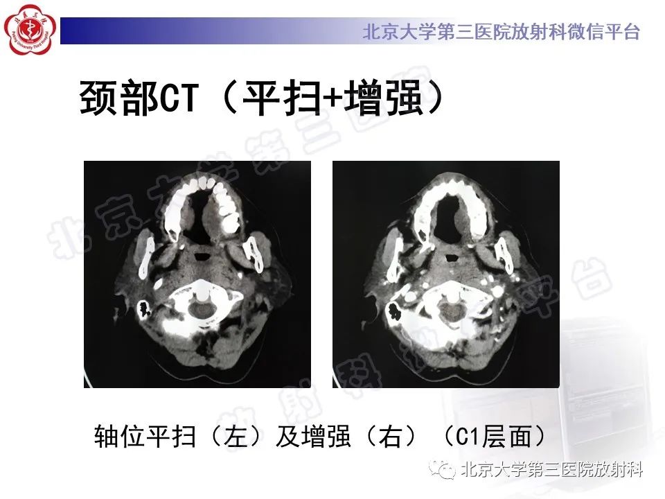 影像PPT - 【PPT】甲状旁腺腺瘤自发破裂-4