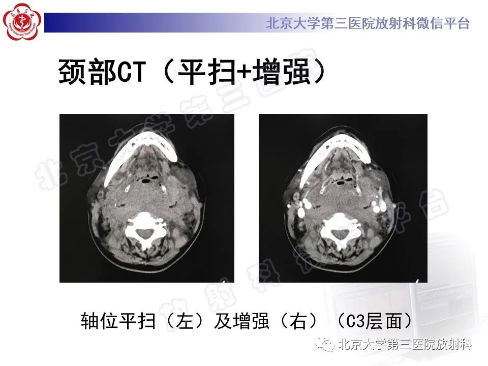 影像PPT - 【PPT】甲状旁腺腺瘤自发破裂-5