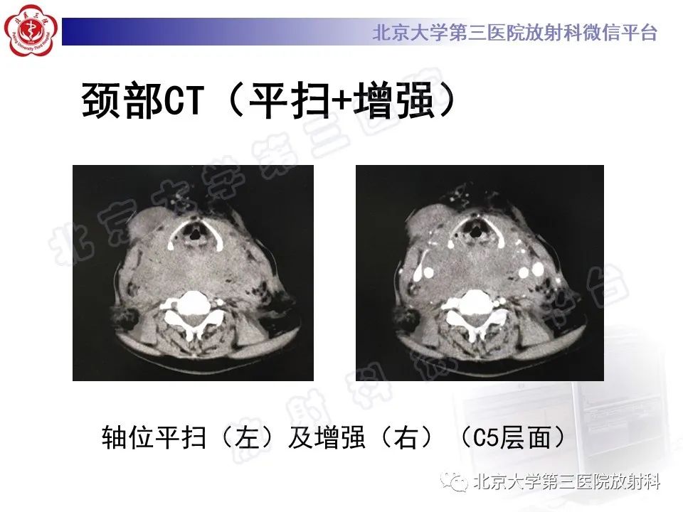 影像PPT - 【PPT】甲状旁腺腺瘤自发破裂-6