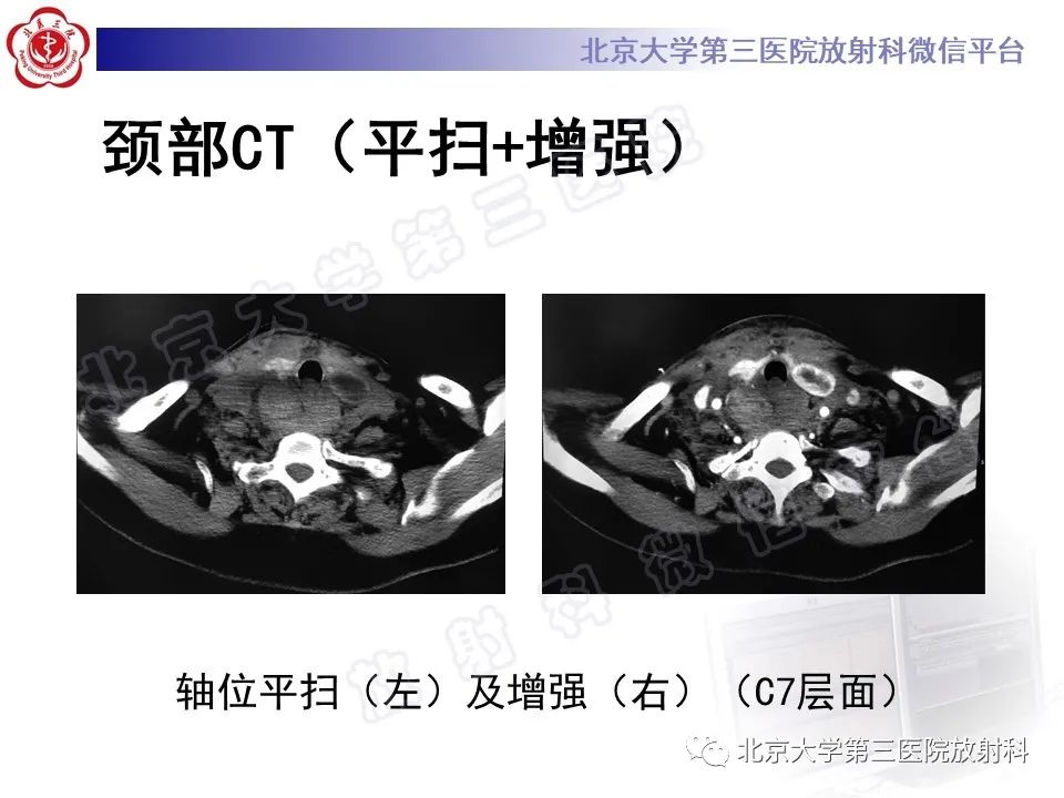 影像PPT - 【PPT】甲状旁腺腺瘤自发破裂-7