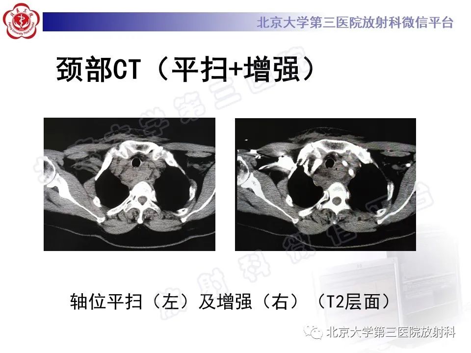 影像PPT - 【PPT】甲状旁腺腺瘤自发破裂-8