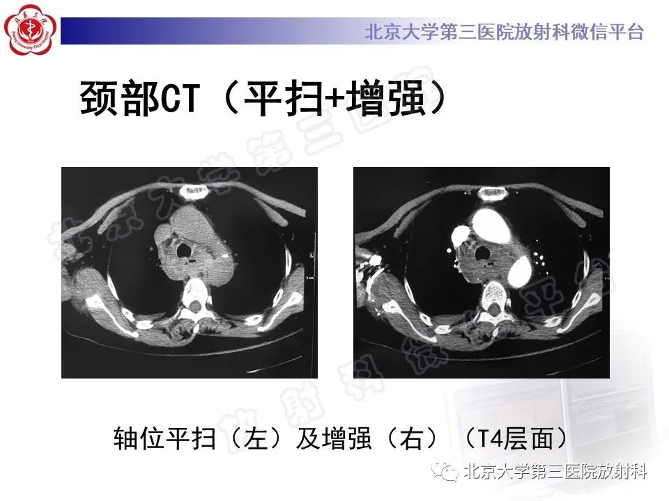 影像PPT - 【PPT】甲状旁腺腺瘤自发破裂-9