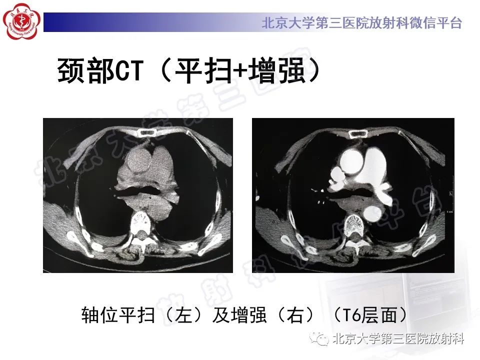 影像PPT - 【PPT】甲状旁腺腺瘤自发破裂-10