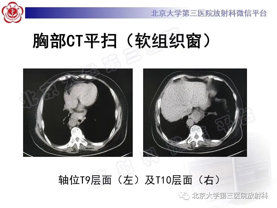影像PPT - 【PPT】甲状旁腺腺瘤自发破裂-11