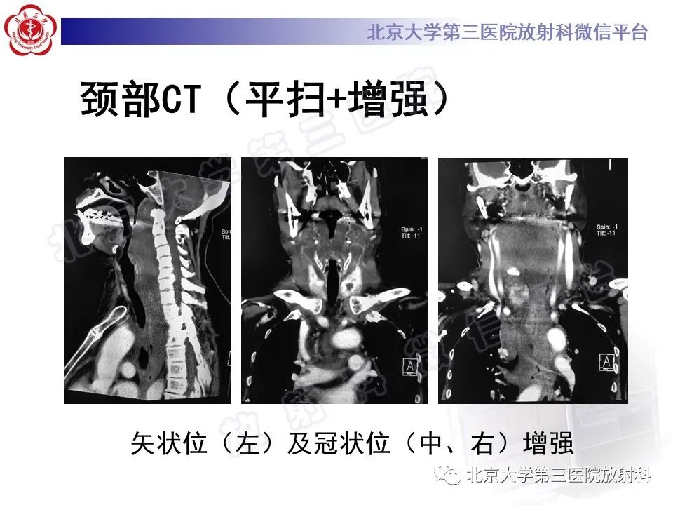 影像PPT - 【PPT】甲状旁腺腺瘤自发破裂-12