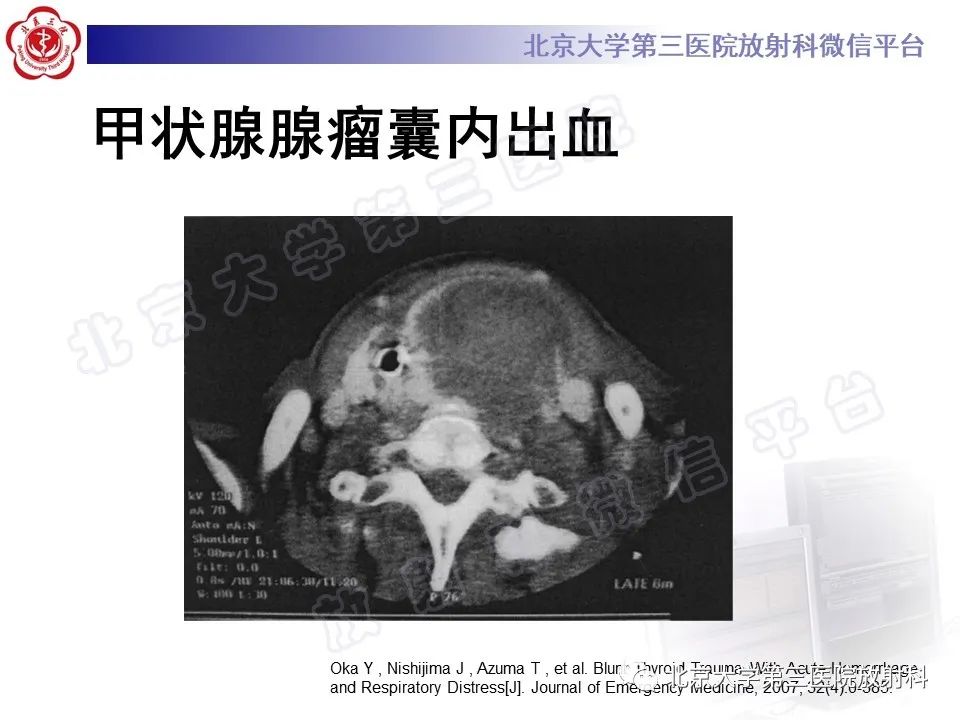 影像PPT - 【PPT】甲状旁腺腺瘤自发破裂-26