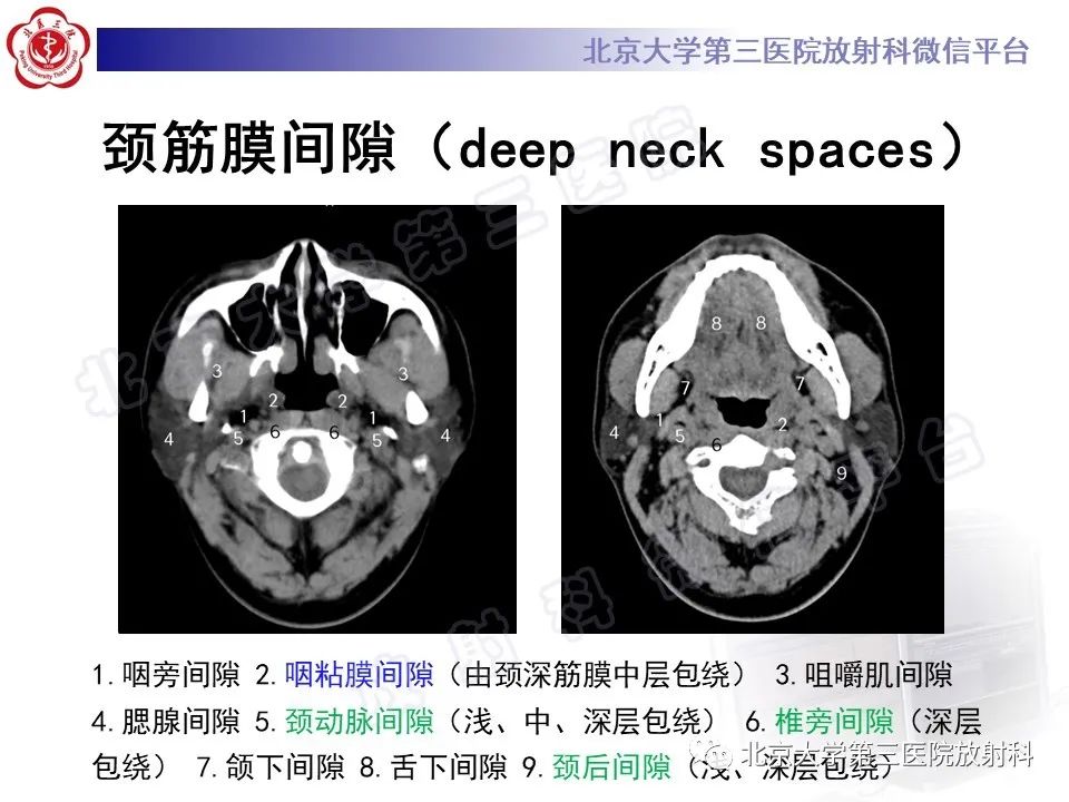 影像PPT - 【PPT】甲状旁腺腺瘤自发破裂-21