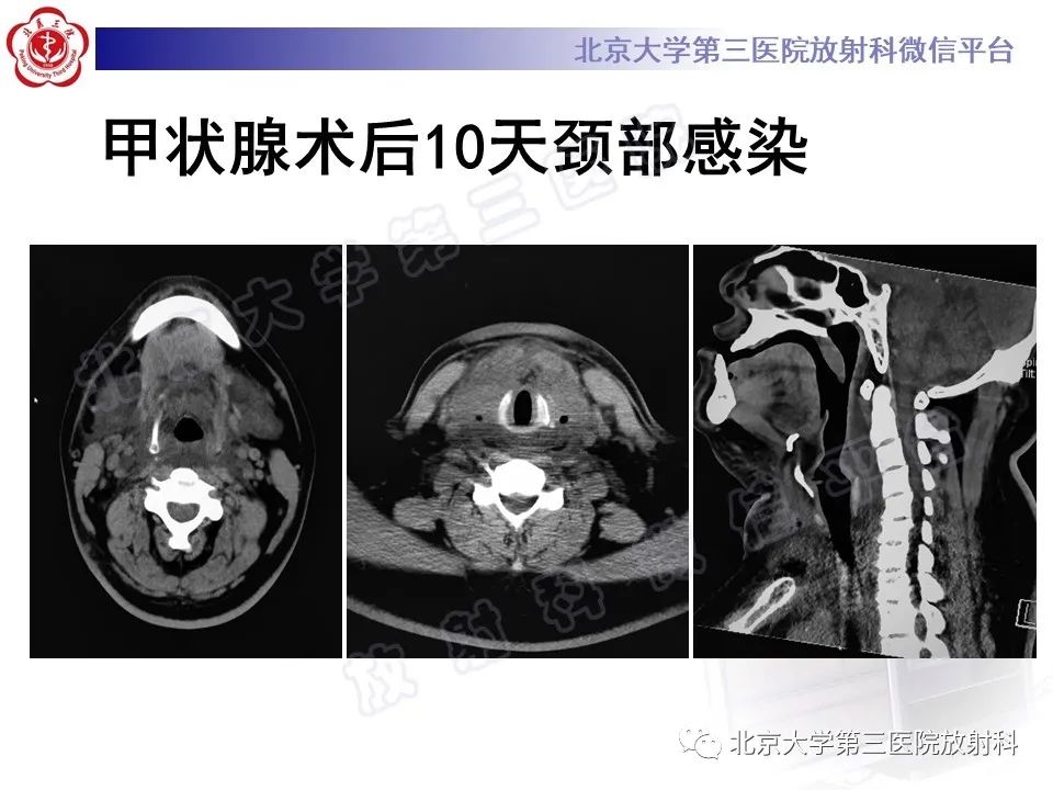 影像PPT - 【PPT】甲状旁腺腺瘤自发破裂-28