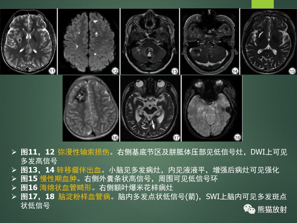 影像PPT - 【PPT】颅内T2WI低信号疾病诊断思路分析-16
