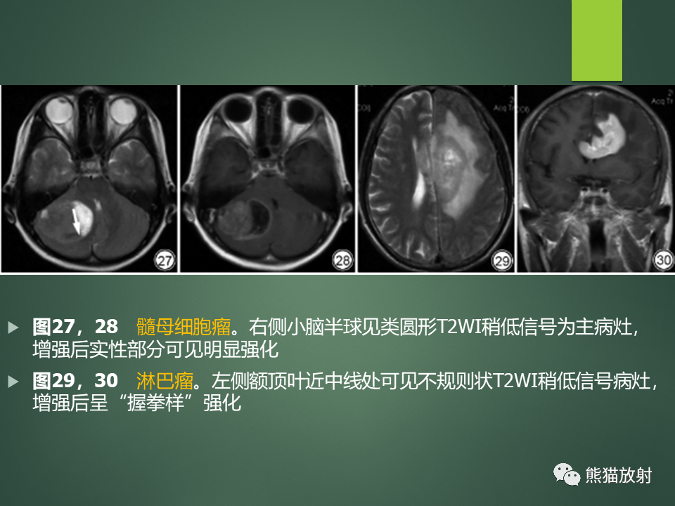 影像PPT - 【PPT】颅内T2WI低信号疾病诊断思路分析-23