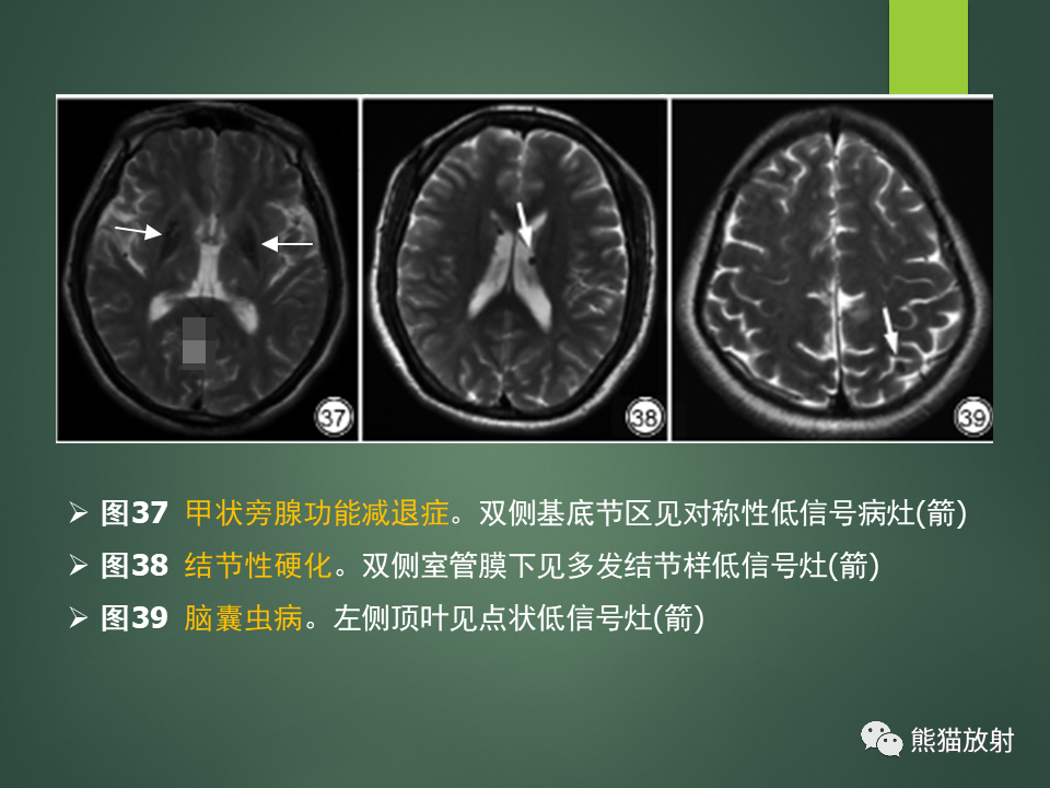 影像PPT - 【PPT】颅内T2WI低信号疾病诊断思路分析-31