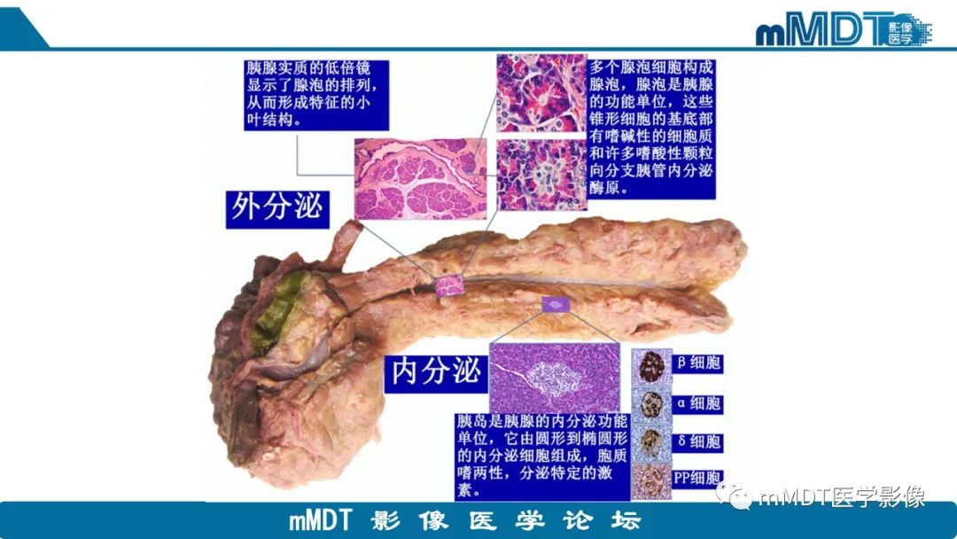 影像PPT - 【PPT】胰腺神经内分泌瘤分级影像对照及鉴别诊断-4 影像PPT - 【PPT】胰腺神经内分泌瘤分级影像对照及鉴别诊断-4