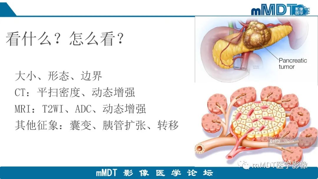 影像PPT - 【PPT】胰腺神经内分泌瘤分级影像对照及鉴别诊断-8 影像PPT - 【PPT】胰腺神经内分泌瘤分级影像对照及鉴别诊断-8