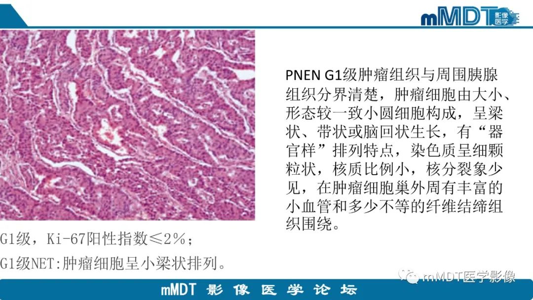 影像PPT - 【PPT】胰腺神经内分泌瘤分级影像对照及鉴别诊断-9 影像PPT - 【PPT】胰腺神经内分泌瘤分级影像对照及鉴别诊断-9