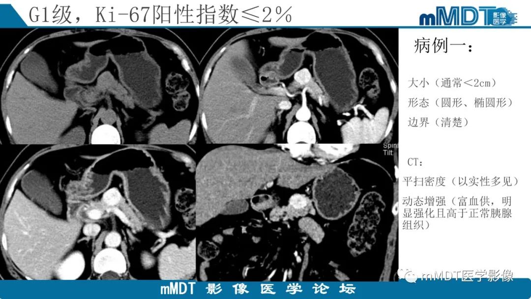 影像PPT - 【PPT】胰腺神经内分泌瘤分级影像对照及鉴别诊断-11 影像PPT - 【PPT】胰腺神经内分泌瘤分级影像对照及鉴别诊断-11