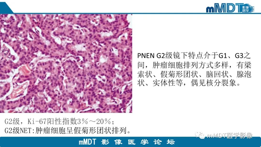 影像PPT - 【PPT】胰腺神经内分泌瘤分级影像对照及鉴别诊断-13 影像PPT - 【PPT】胰腺神经内分泌瘤分级影像对照及鉴别诊断-13