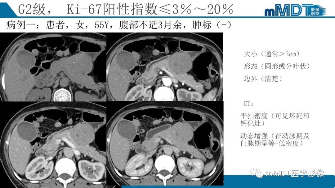 影像PPT - 【PPT】胰腺神经内分泌瘤分级影像对照及鉴别诊断-15 影像PPT - 【PPT】胰腺神经内分泌瘤分级影像对照及鉴别诊断-15