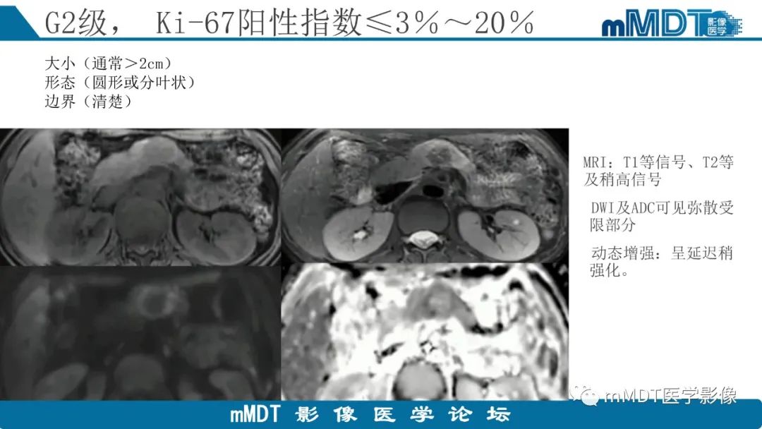 影像PPT - 【PPT】胰腺神经内分泌瘤分级影像对照及鉴别诊断-18 影像PPT - 【PPT】胰腺神经内分泌瘤分级影像对照及鉴别诊断-18