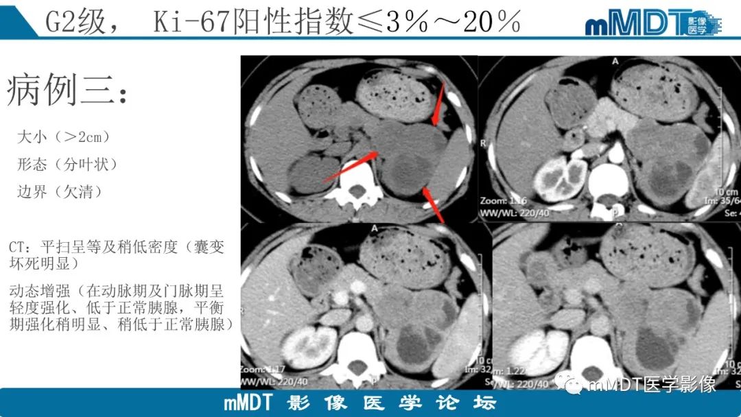 影像PPT - 【PPT】胰腺神经内分泌瘤分级影像对照及鉴别诊断-21 影像PPT - 【PPT】胰腺神经内分泌瘤分级影像对照及鉴别诊断-21
