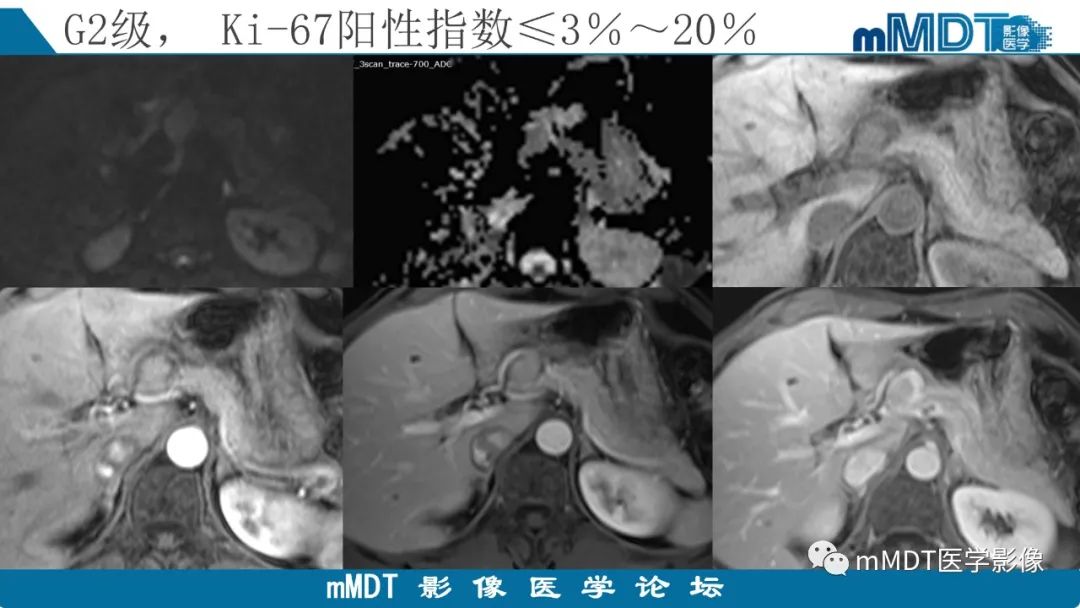 影像PPT - 【PPT】胰腺神经内分泌瘤分级影像对照及鉴别诊断-17 影像PPT - 【PPT】胰腺神经内分泌瘤分级影像对照及鉴别诊断-17