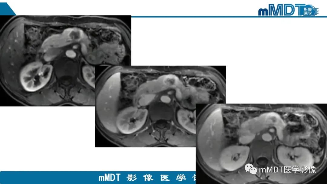 影像PPT - 【PPT】胰腺神经内分泌瘤分级影像对照及鉴别诊断-19 影像PPT - 【PPT】胰腺神经内分泌瘤分级影像对照及鉴别诊断-19