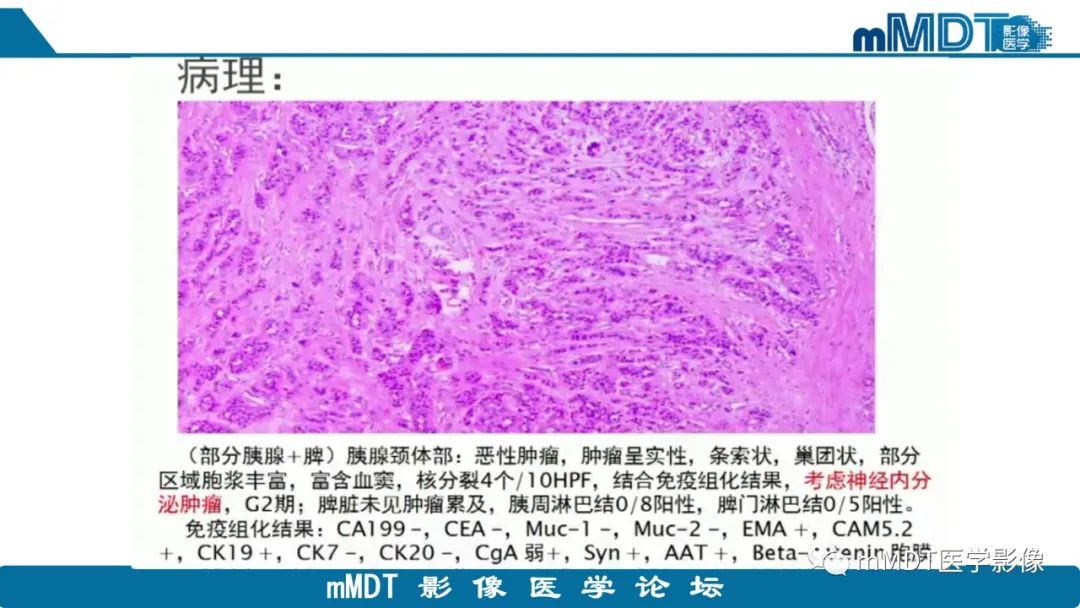 影像PPT - 【PPT】胰腺神经内分泌瘤分级影像对照及鉴别诊断-20 影像PPT - 【PPT】胰腺神经内分泌瘤分级影像对照及鉴别诊断-20