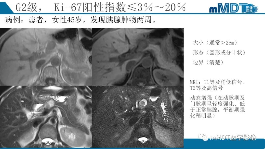影像PPT - 【PPT】胰腺神经内分泌瘤分级影像对照及鉴别诊断-16 影像PPT - 【PPT】胰腺神经内分泌瘤分级影像对照及鉴别诊断-16