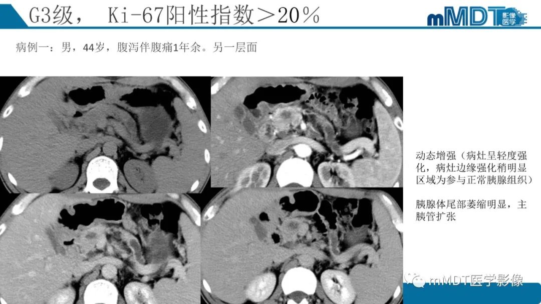 影像PPT - 【PPT】胰腺神经内分泌瘤分级影像对照及鉴别诊断-26 影像PPT - 【PPT】胰腺神经内分泌瘤分级影像对照及鉴别诊断-26