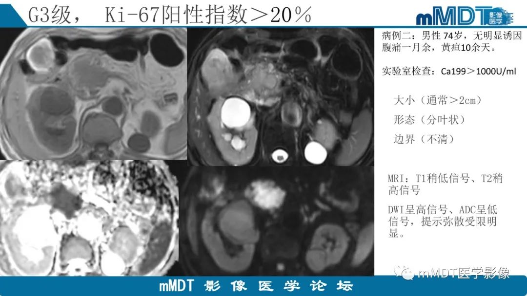 影像PPT - 【PPT】胰腺神经内分泌瘤分级影像对照及鉴别诊断-27 影像PPT - 【PPT】胰腺神经内分泌瘤分级影像对照及鉴别诊断-27