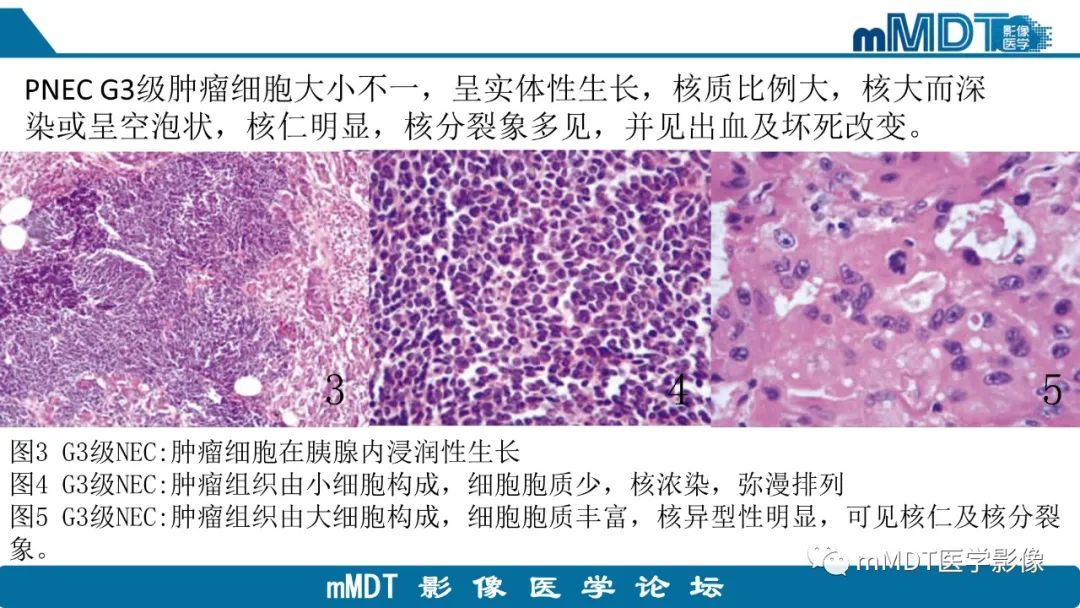 影像PPT - 【PPT】胰腺神经内分泌瘤分级影像对照及鉴别诊断-23 影像PPT - 【PPT】胰腺神经内分泌瘤分级影像对照及鉴别诊断-23