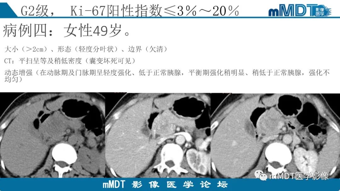 影像PPT - 【PPT】胰腺神经内分泌瘤分级影像对照及鉴别诊断-22 影像PPT - 【PPT】胰腺神经内分泌瘤分级影像对照及鉴别诊断-22
