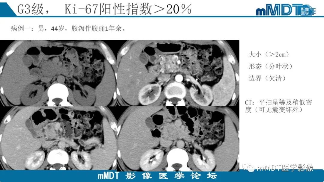 影像PPT - 【PPT】胰腺神经内分泌瘤分级影像对照及鉴别诊断-25 影像PPT - 【PPT】胰腺神经内分泌瘤分级影像对照及鉴别诊断-25
