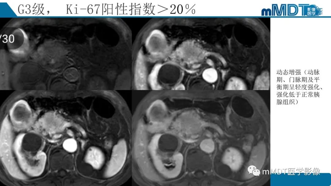 影像PPT - 【PPT】胰腺神经内分泌瘤分级影像对照及鉴别诊断-28 影像PPT - 【PPT】胰腺神经内分泌瘤分级影像对照及鉴别诊断-28