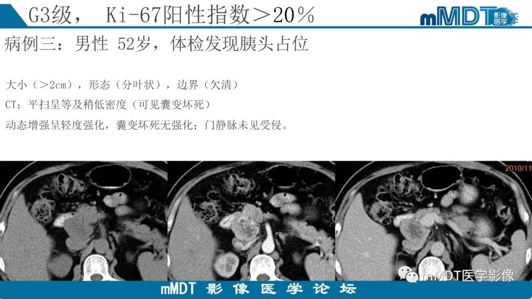 影像PPT - 【PPT】胰腺神经内分泌瘤分级影像对照及鉴别诊断-29 影像PPT - 【PPT】胰腺神经内分泌瘤分级影像对照及鉴别诊断-29