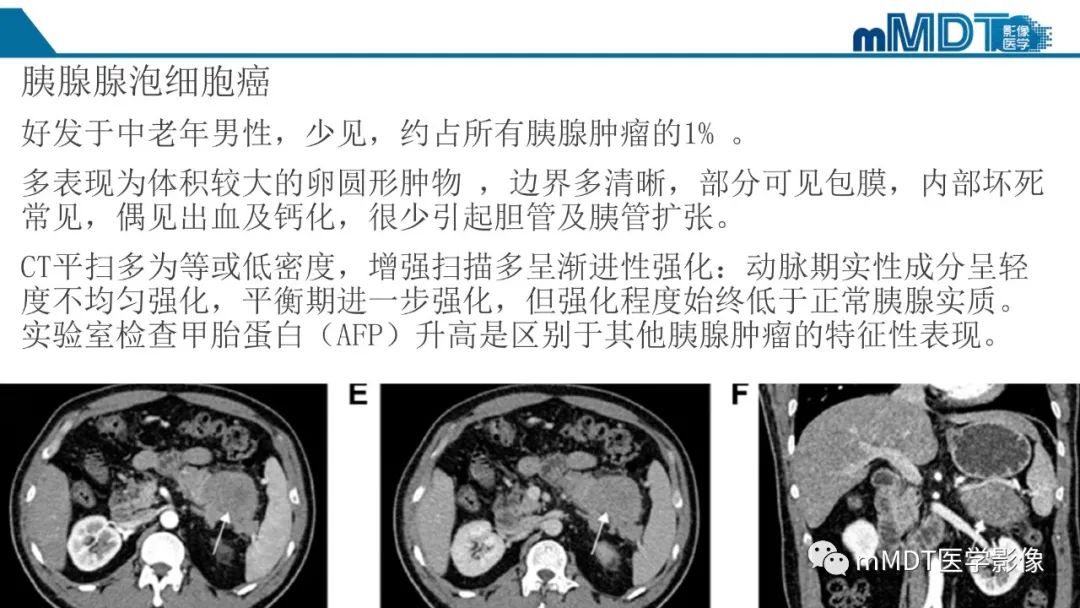 影像PPT - 【PPT】胰腺神经内分泌瘤分级影像对照及鉴别诊断-32 影像PPT - 【PPT】胰腺神经内分泌瘤分级影像对照及鉴别诊断-32