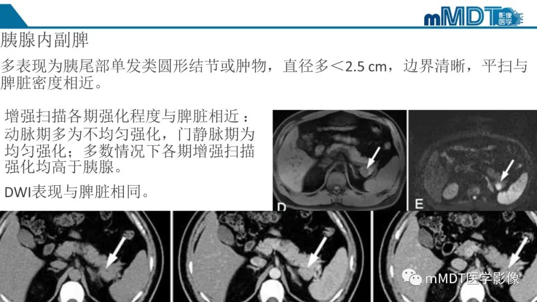影像PPT - 【PPT】胰腺神经内分泌瘤分级影像对照及鉴别诊断-33 影像PPT - 【PPT】胰腺神经内分泌瘤分级影像对照及鉴别诊断-33